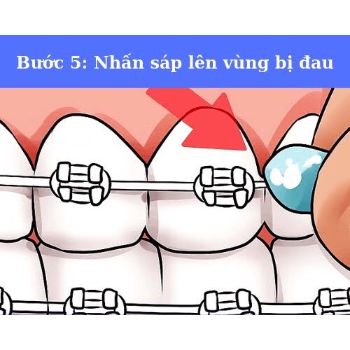 Sáp nha khoa, sáp chỉnh nha 3M, Dental Wax 3M