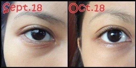 KEM GIẢM THÂM MẮT KUMARGIC EYE