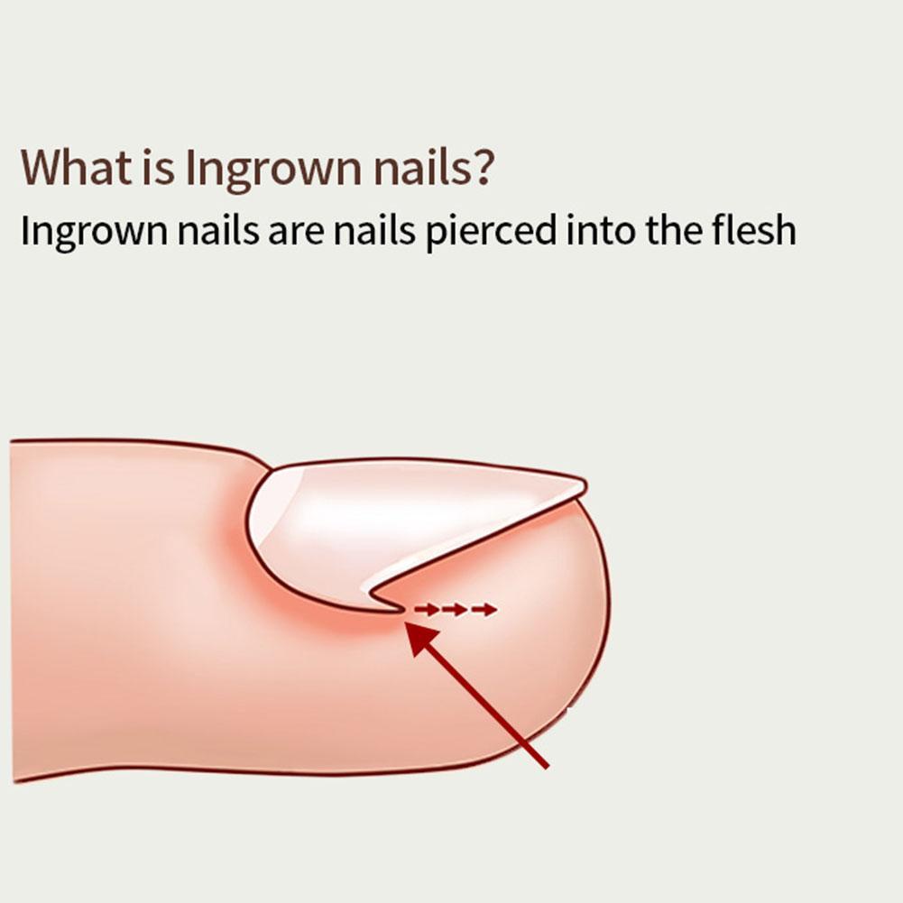 Bộ dụng cụ chỉnh hình móng chân co giãn U2W3