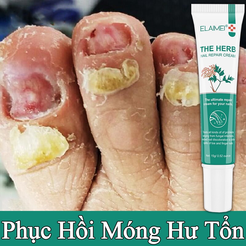 Kem tẩy nấm móng Kem dưỡng tinh chất phục hồi móng chân 15g loại bỏ móng hoại tử loại bỏnấm chăm sóc móng