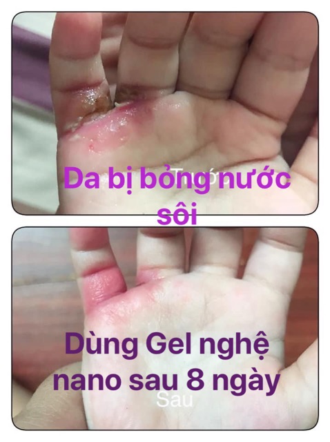 Gel Nghệ Nano Ngừa thâm nám Oshara ⭐️Giảm thâm nám, xoá mờ sẹo, giúp vết thương mau lành, làm trắng da
