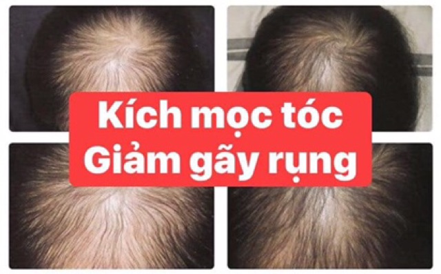 Tinh Dầu Bưởi Dưỡng Tóc Thuỷ Mộc Dạng Xịt Ngăn Rụng Tóc Kích Mọc Tóc Dài Dùng Được Cho Người Ít Tóc Hói Đầu | BigBuy360 - bigbuy360.vn