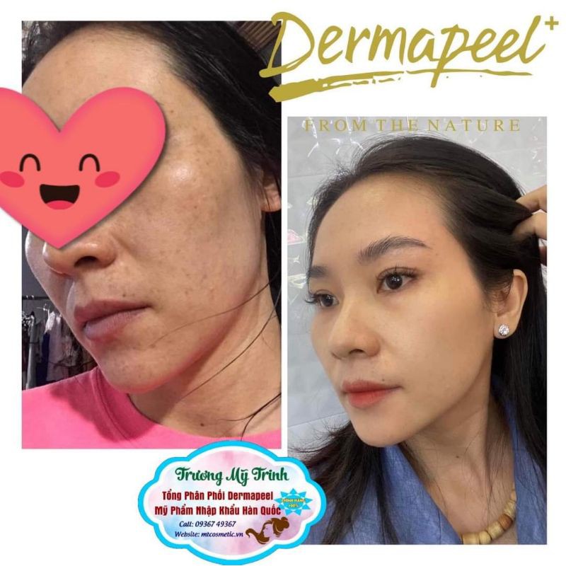 [Combo tảo + bộ dưỡng] Bộ tảo Dermapeel kết hợp bộ dưỡng dành cho Da mụn - Sạch mụn - mờ thâm - bảo vệ phục hồi da