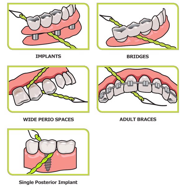 Chỉ chuyên dụng X-Floss và X-Ribbon dành cho cầu răng và Implant - Úc Chính hãng