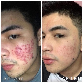 [Bản Cải Tiến 2021] Serum Lumos Acne Ngừa Mụn