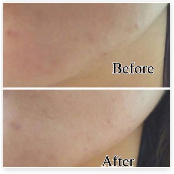 [Mã giảm giá] Kem Dưỡng Dạng Gel Làm Mờ Sẹo Mụn Và Thâm Mụn Hiruscar Post Acne Gel For Acne Scar And Dark Marks