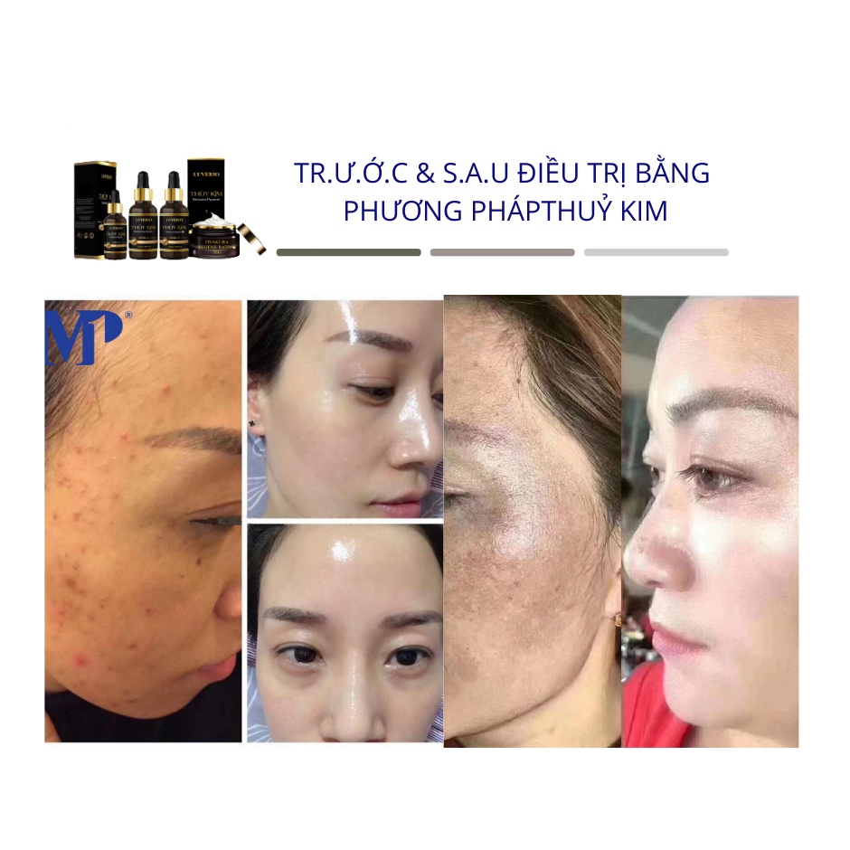Thủy Kim Số 3 Serum LUVERIO OSAKURA - Skin Recovery Xóa Mụn Nám, Sẹo Thâm - Thủy Kim 03