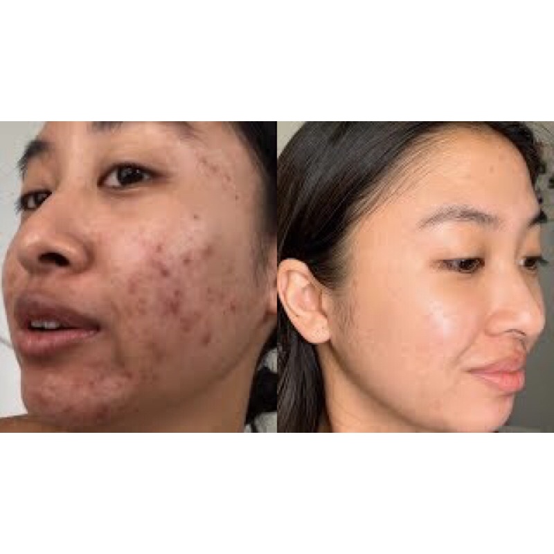 kem bôi mụn đầu đen sợi bã nhờn mờ thâm mụn dưỡng sáng da Azelaic Acid 20% | BigBuy360 - bigbuy360.vn