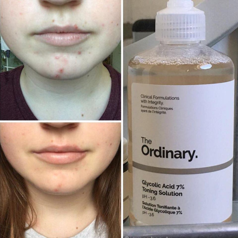 Toner Tẩy Da Chết The Ordinary Glycolic Acid 7% Toning Solution