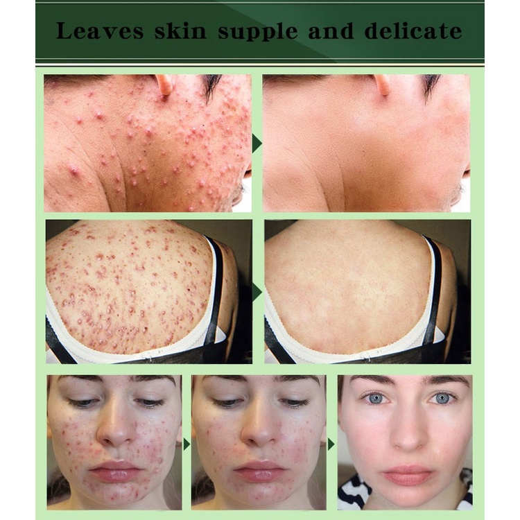 Kem Hỗ Trợ Giảm Mụn Xóa Sẹo Thu Nhỏ Lỗ Chân Lông Chăm Sóc Da Mặt 20g