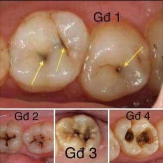 Trị sâu răng, nấm lưỡi, viêm họng,Amiđan