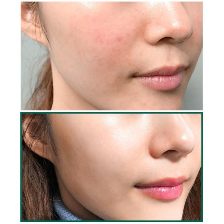 Hàng Hàn- Sữa Rửa Mặt &quot;Thần Kỳ&quot; Some By Mi AHA-BHA-PHA 30 Days Miracel Acne Clear Foam 100ml