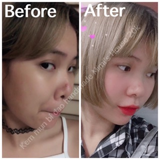 KEM MỤN BÍ ĐAO SIZE LỚN 20G