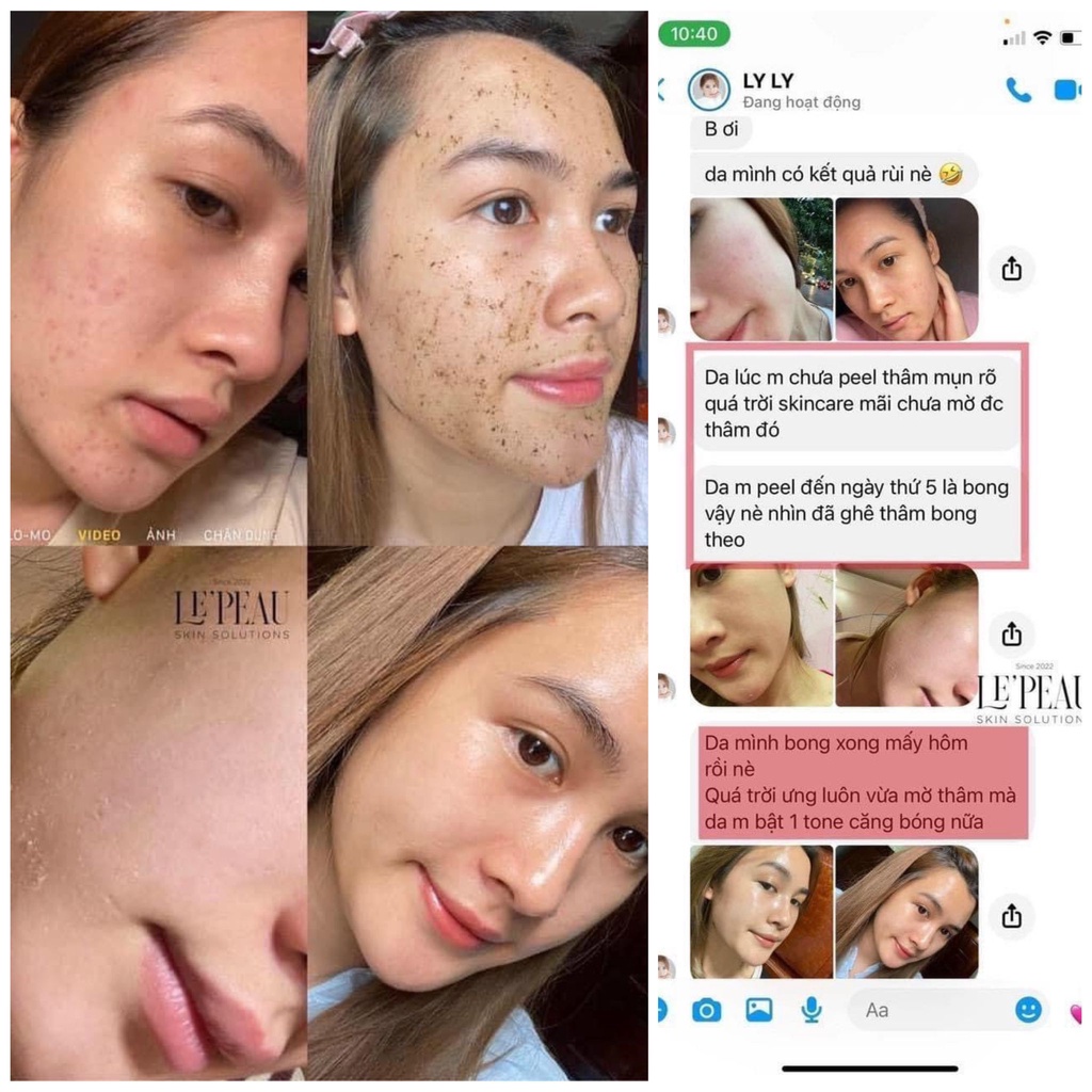 LE’PEAU - Peel da Vi Tảo Retinol của công ty Việt Nam