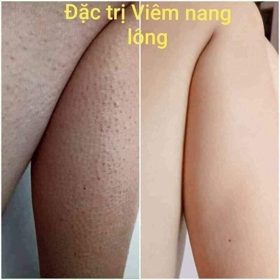 Kem giảm viêm nang lông Zaraporo Rohto, cải thiện tình trạng da khô, chai sạn 35g