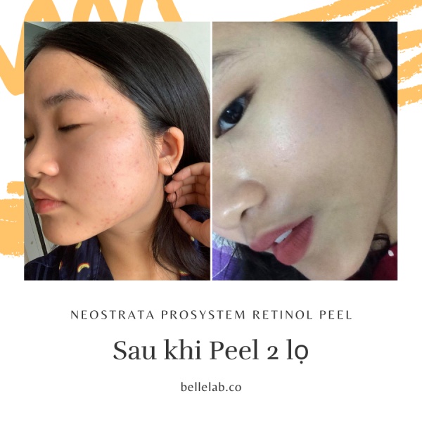 1 lọ Peel Da Sinh Học Siêu Cấp NeoStrata ProSystem Retinol Peel 1.5ml