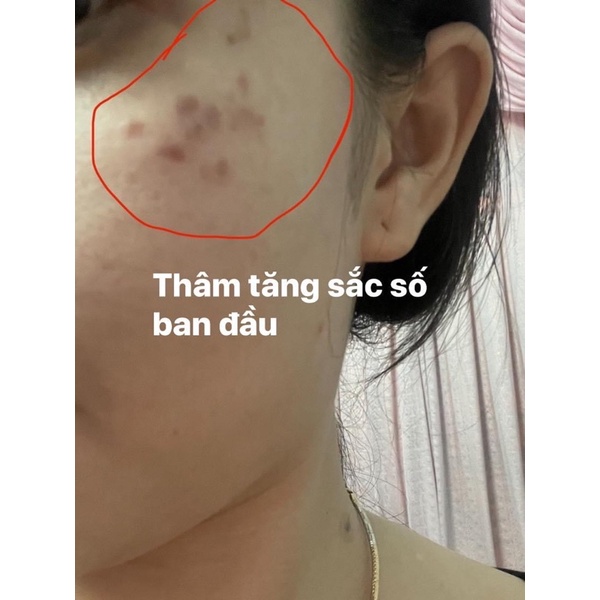 Phân giải sắc tố B1 tái tạo da loại 1 ngăn ngừa thâm, nám mảng, tàn nhang, chống tăng sắc tố Handmde