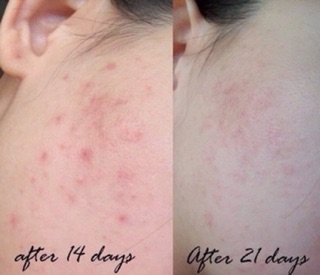 Serum Blance Vitamin C