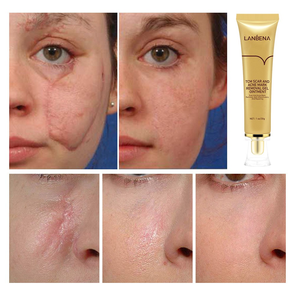 Set 2 Mỹ Phẩm Chăm Sóc Da LANBENA Gồm Serum Xóa Sẹo Mụn+Kem Làm Trắng Mụn Đầu Đen Thu Nhỏ Lỗ Chân Lông Làm Mờ Vết Rạn Da | BigBuy360 - bigbuy360.vn