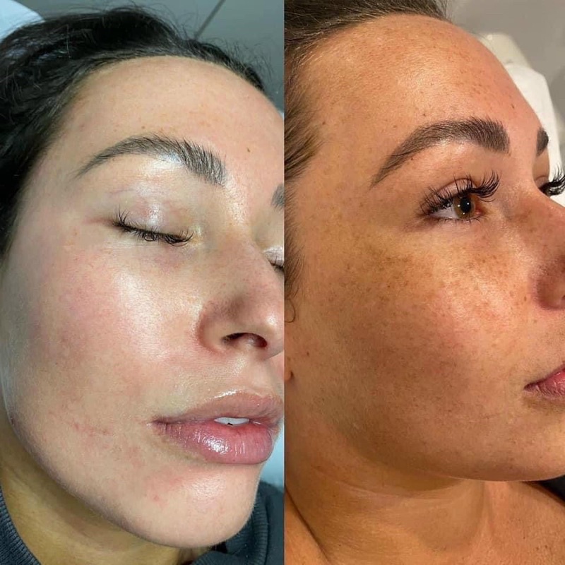 Kem giảm nám sáng da mờ thâm Cosmelan 2 Mesoestetic Fullsize 30gr