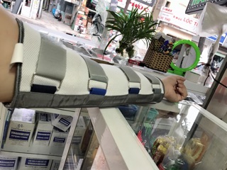 Nẹp bắp tay,cánh tay dài