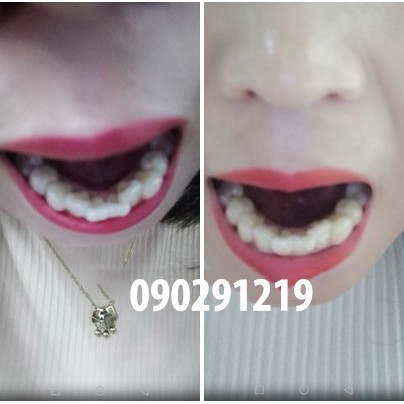 BỘ NIỀNG RĂNG TẠI NHÀ 4D| dùng cho NGƯỜI LỚN