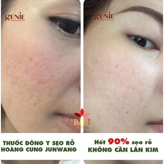 [Chính Hãng Genie + Tặng Soap] Kem Sẹo Genie Fix Skin No – MTS 30g Korea