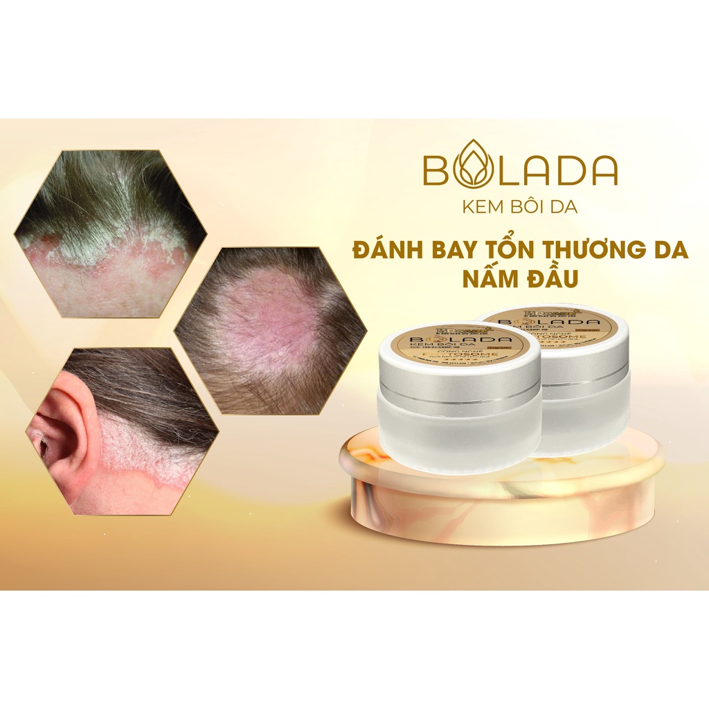Kem bôi da Bolada phòng ngữa các bệnh ngoài da ngăn ngừa và loại bỏ các loại nấm trên da