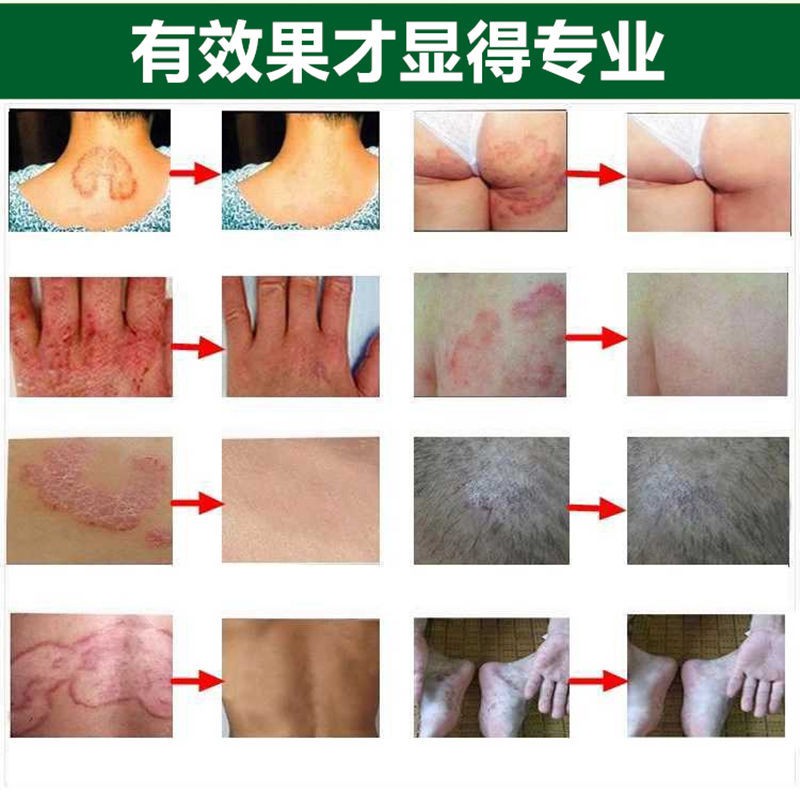 (Hàng Mới Về) Kem Trị Vẩy Nến Eczema Hearttium 15g