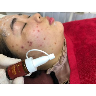 SERUM ACNE AMPOULE DNA CÁ HỒI (LOẠI BỎ MỤN TẬN GỐC)