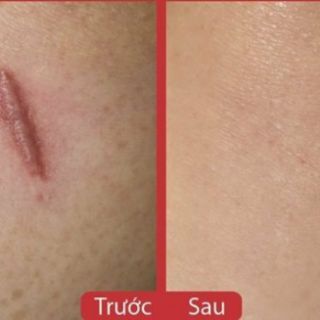 Trị Sẹo Nga