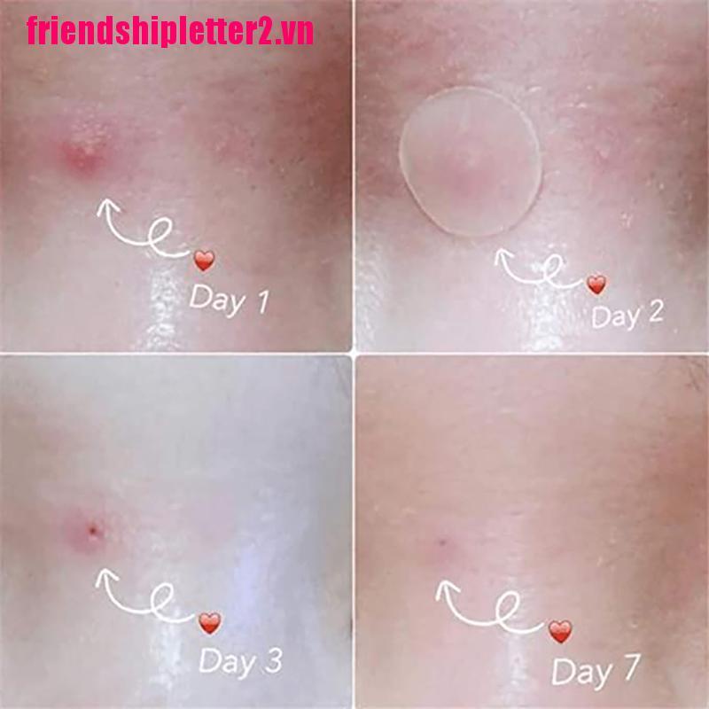 (Hàng Mới Về) Set 36 Miếng Dán Trị Mụn Chăm Sóc Da Hiệu Quả | BigBuy360 - bigbuy360.vn