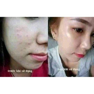 combo 5 hộp face mụn( mua 10hộp tặng 1 hộp)