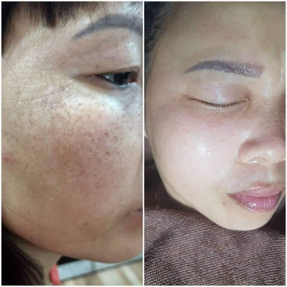 Mỹ Phẩm Làm Mờ Nám Yiyimei 5in Phục Hồi Và Tái Tạo Làn Da, Đem Lại Vẻ Trắng Sáng, Trẻ Đẹp Của Làn Da