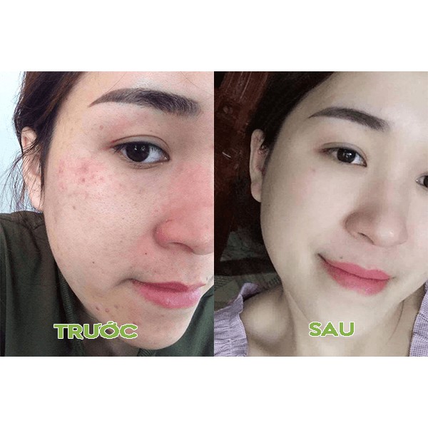 Serum Skin Care N-Collagen 10ml - Loại bỏ mụn nám tàn nhan sẵn