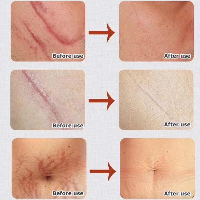 Kem xóa sẹo Kem sẹo Scar Care 50g sẹo do bị thương sẹo bỏng sẹo phẫu thuật sửa chữa tất cả các loại của vết sẹo