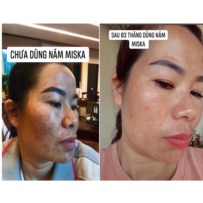 [CHÍNH HÃNG] Combo Kem Nám Dưỡng Trắng Da Miska Skin