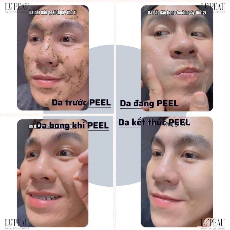 Peel Vi Tảo Retinol Giúp Cải Thiện Tình Trạng Mụn - LE'PEAU