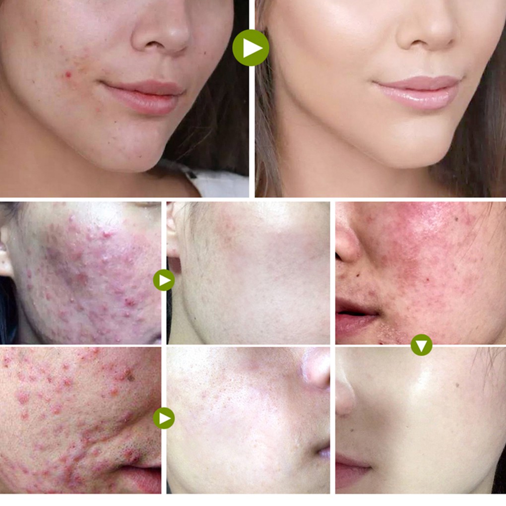 [Hàng mới về] Kem Hỗ Trợ Giảm mụn BREYLEE giúp kiềm dầu cao cấp
