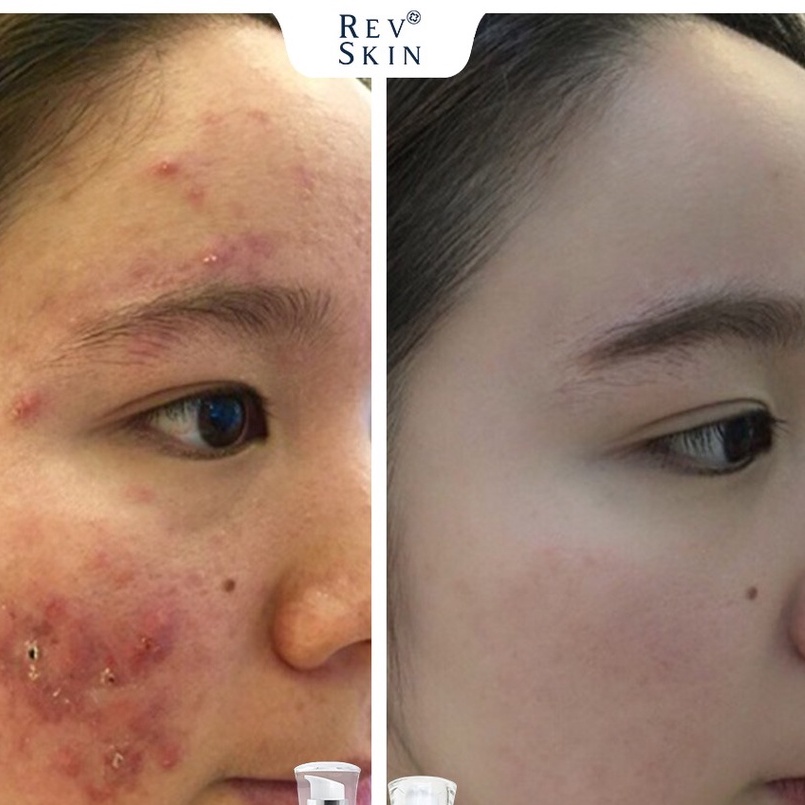 [DƯỢC MỸ PHẨM] Chấm Mụn Giảm Mụn, Giảm Thâm, Sẹo Rỗ RevSkin Acne Cực Kỳ Hiệu Qủa