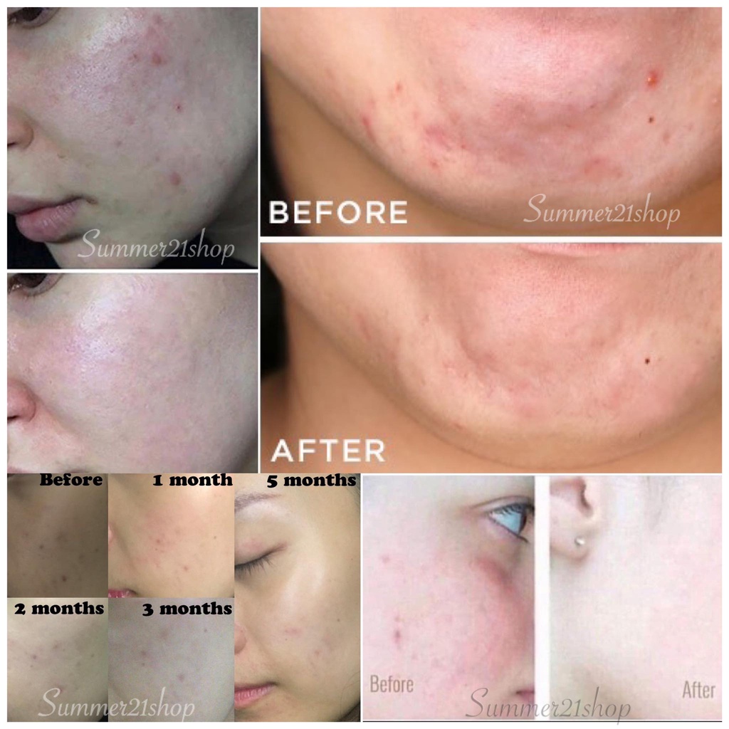 Tinh Chất Ngừa Mụn, Sáng Da, Cân Bằng Bã Nhờn, Thu Nhỏ Lỗ Chân Lông The Ordinary Niacinamide 10% + Zinc 1%