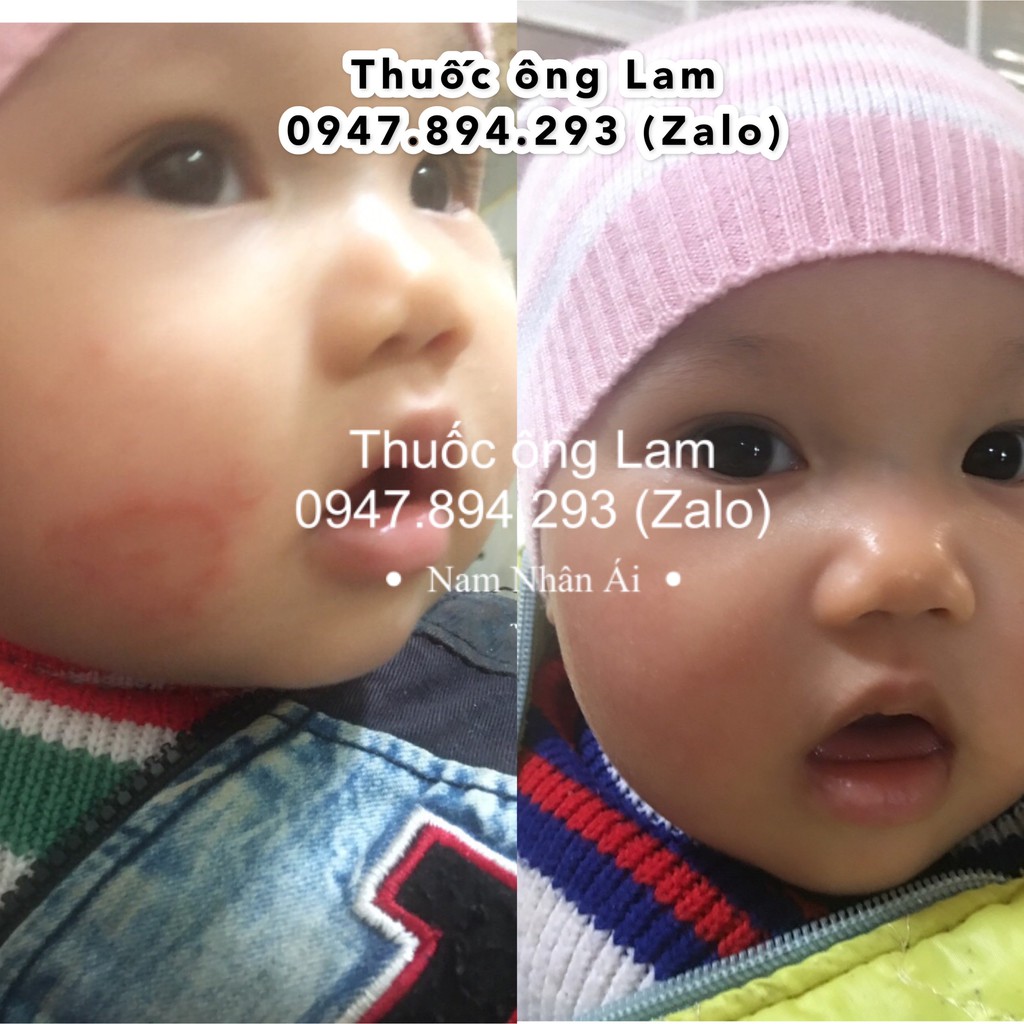 Hắc lào, nấm bẹn dứt điểm Đông Y gia truyền Ông Lam | BigBuy360 - bigbuy360.vn