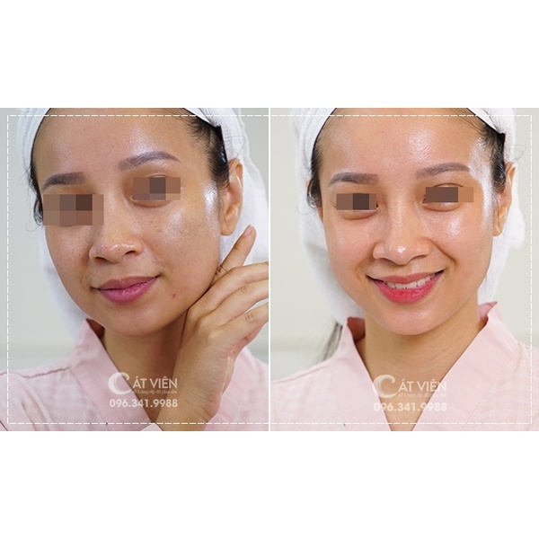 Lăn kim, phi kim da nám, tàn nhang, trẻ hóa, căng bóng da, hết sẹo - Hàng chính hãng Hàn Quốc DBO Derma-Q