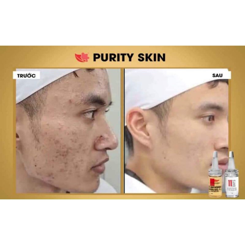 BỘ SERUM DƯỠNG DA CAO CẤP LINH HƯƠNG PURITY SKIN 11ML [Chính Hãng 100%]