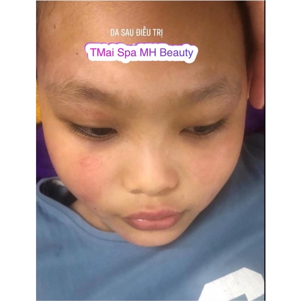 Serum  tinh chất mờ thâm liền sẹo MH Beauty spa
