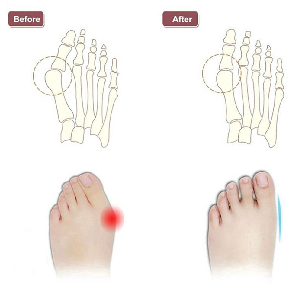 Cặp silicon tách ngón chân bị chứng phù nề chỉnh sửa định hình giảm đau tiện dụng