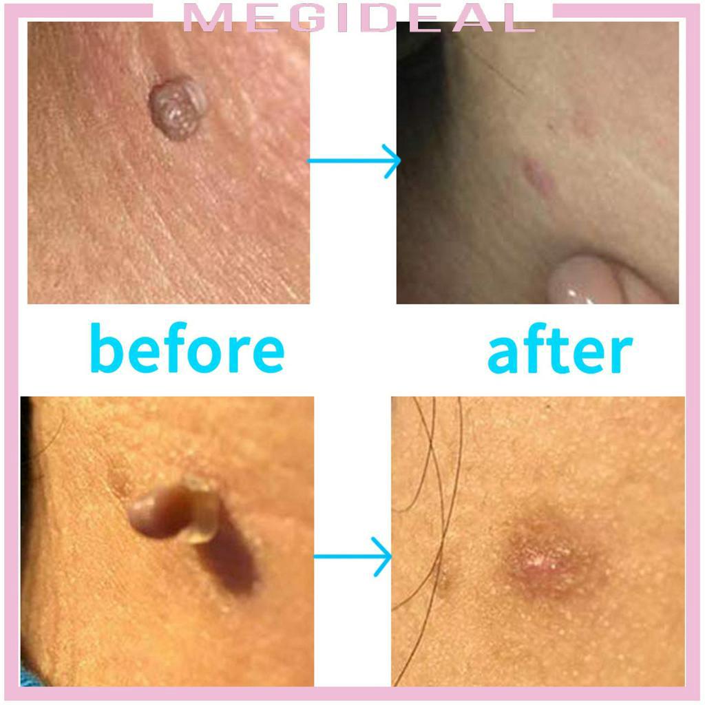 Bộ dụng cụ loại bỏ mụn thịt thừa trên làn da tiện lợi