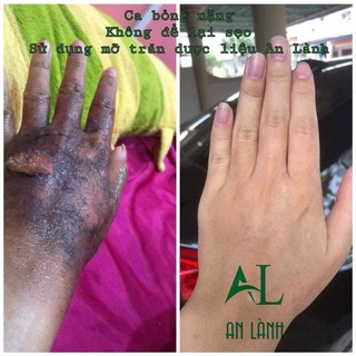 MỠ TRĂN DƯỢC LIỆU AN LÀNH