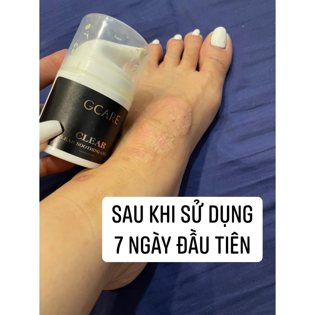 Kem bôi da liễu đa năng GCARE về các vấn đề mẩn ngứa viêm da công thức đến từ Anh Quốc.