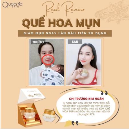 Quế Hoa Mụn Queenie Skin - Kem Chấm Mụn Đậu Đen, Mụn Ẩn, Giảm Thâm Mụn, Dưỡng Trắng Da